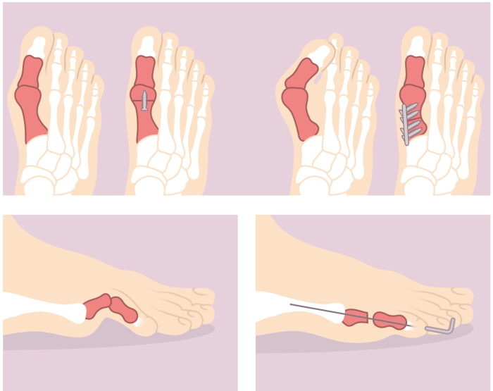 Hallux valgus