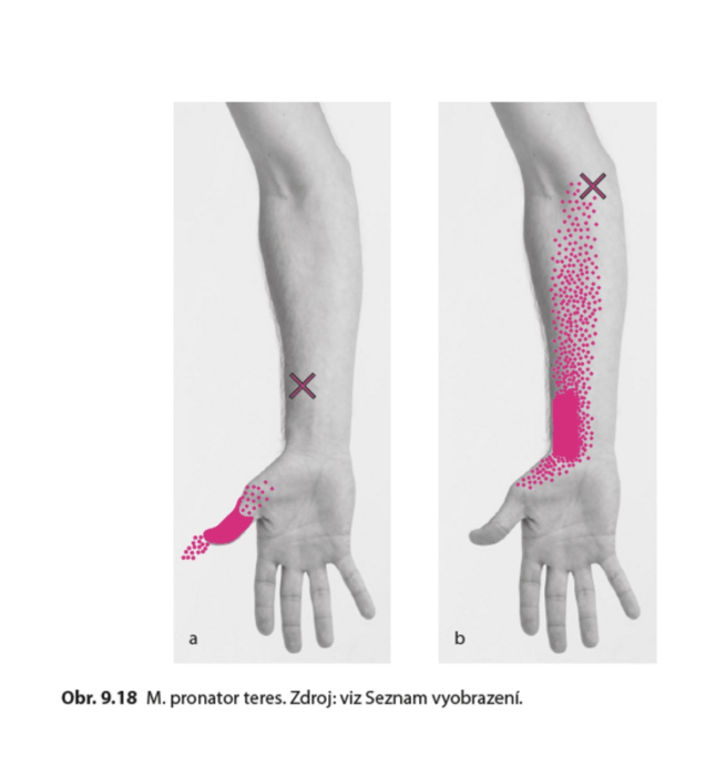 Parietlna osteopatia